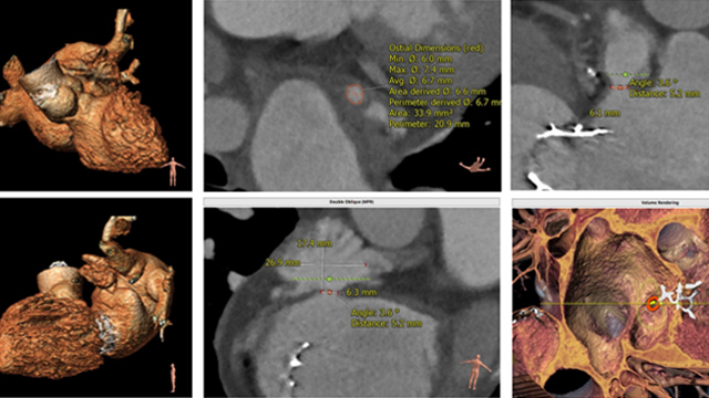 Challenging LAA occlusion cases