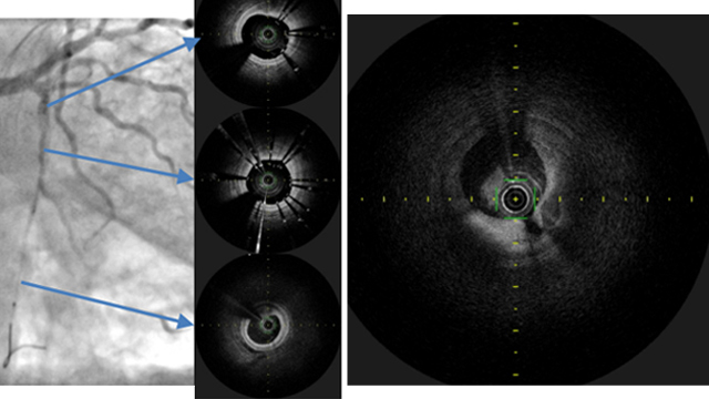 Challenging scenarios in NSTEMI
