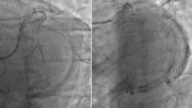 Challenging scenarios in STEMI