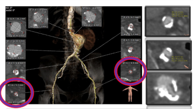 Challenging situations to access the aortic valve - Part 1