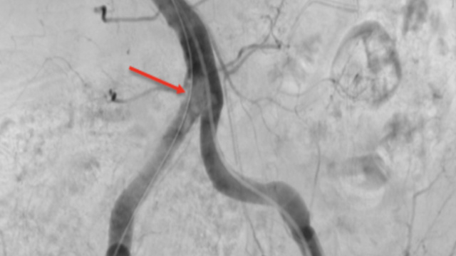 Challenging situations to access the aortic valve - Part 2