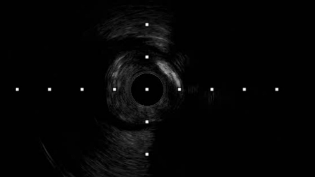 Complex PCI in multivessel disease