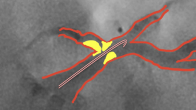 Complex PCI in NSTEMI - Part 1