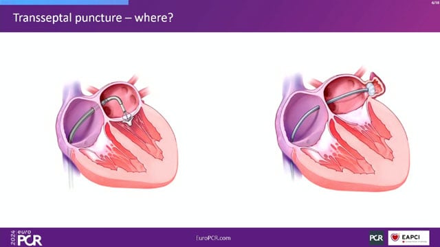 Complicated scenarios in LAA occlusion