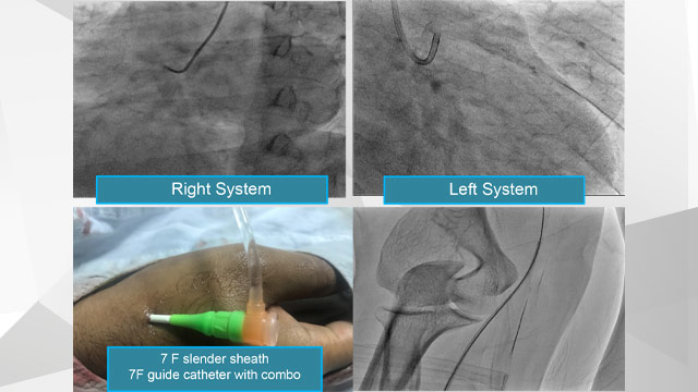 Navigating Complications in Calcified Coronary PCI