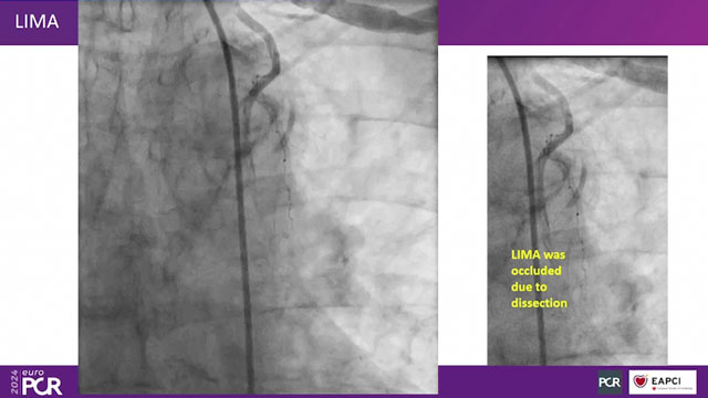 Complications in STEMI: sharing is key