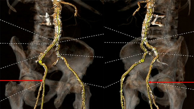 Crossing the finishing line - Latest best practices and technologies for large hole arterial and venous closure