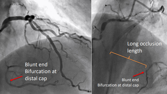 CTO within a bifurcation