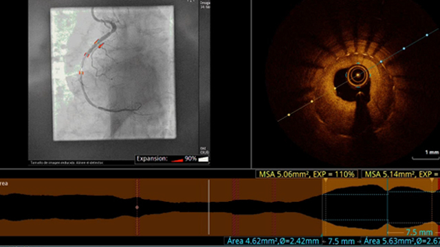 Different treatment options for PCI in calcified lesions