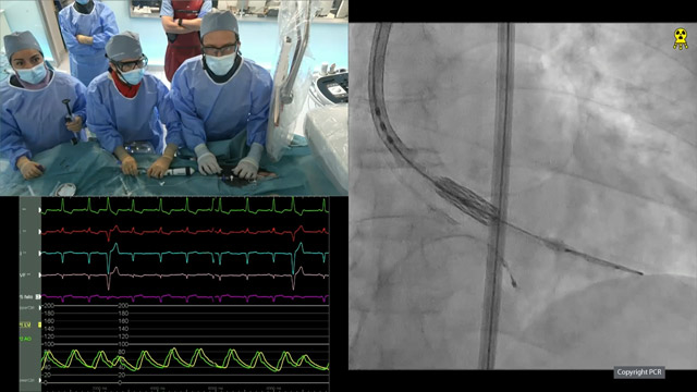 Elevating quality of heart valve treatment through innovation: SAPIEN 3 Ultra RESILIA and EVOQUE valve systems