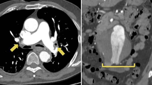 Endovascular thrombectomy for pulmonary embolism