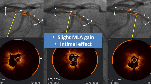Essentials in the management of calcified coronary stenosis