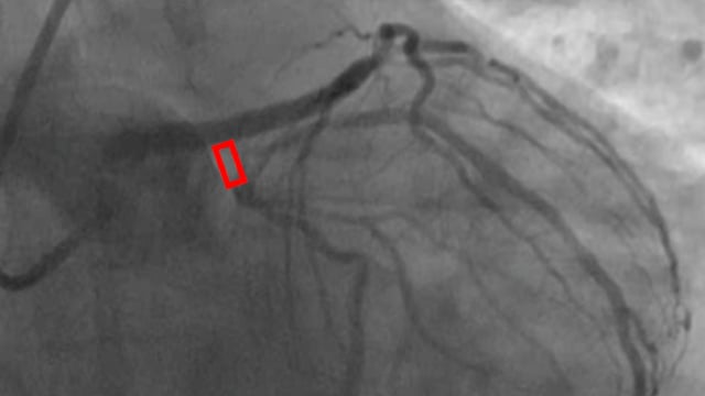 Expanding the indications of DCB for complex PCI scenarios