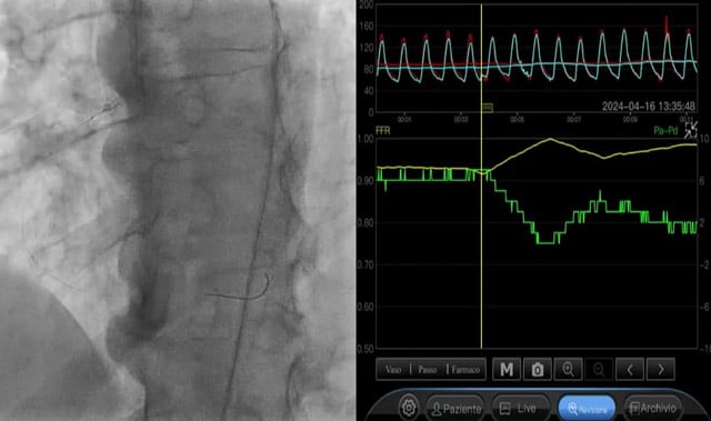 Has the 2023 ESC-EACTS guideline review on left main changed my practice