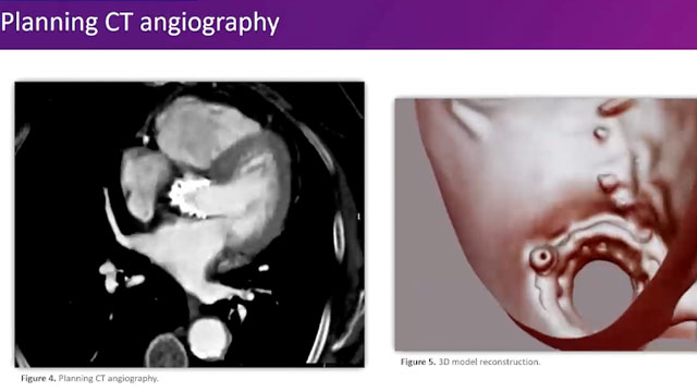 How to solve tricky coronary complications