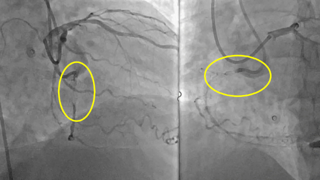How to achieve successful outcome in contemporary CTO PCI