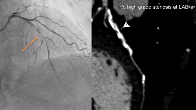 How to obtain the best PCI results in calcified lesions