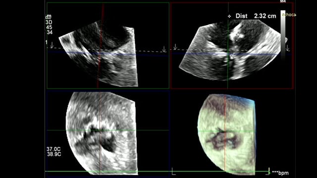 Innovations in TMVR and Intrepid trial updates