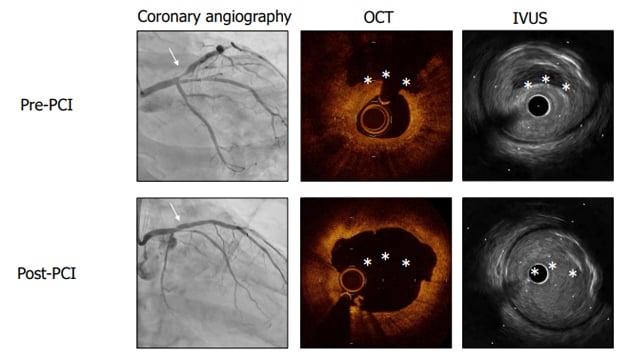 Intracoronary imaging: diagnosis