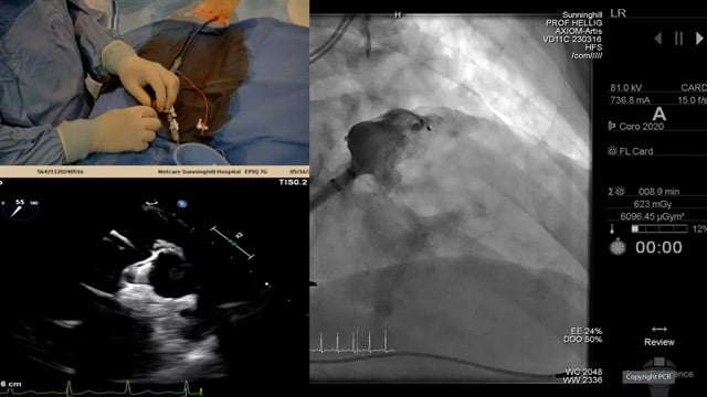LAA closure - LIVE case