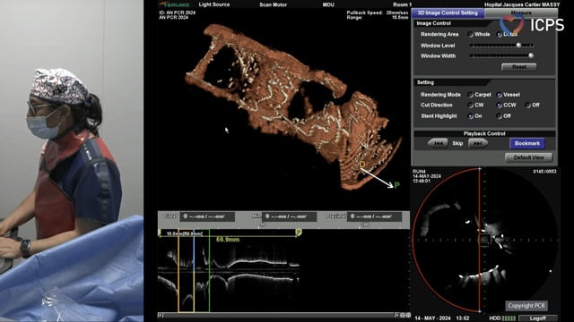 Left main and complex bifurcation stenting