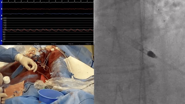 Left main bifurcation and haemodynamic support