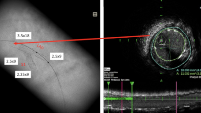 Make your life easier with imaging during primary PCI for acute coronary syndrome