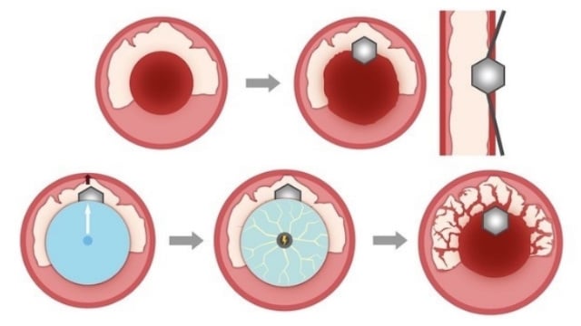 Management complications during PCI of calcified coronary lesions