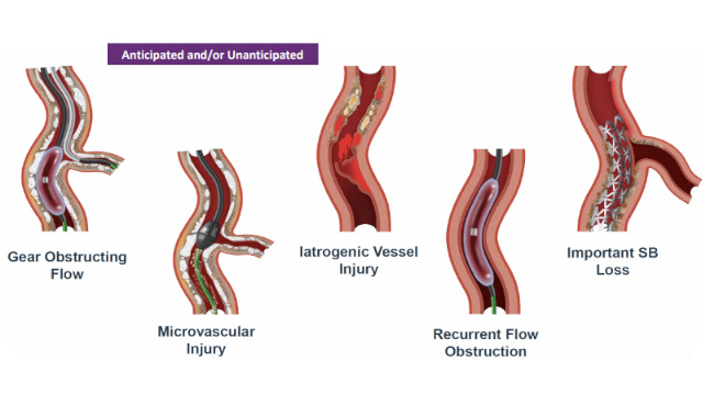 Mechanical circulatory support in cardiogenic shock and high-risk PCI