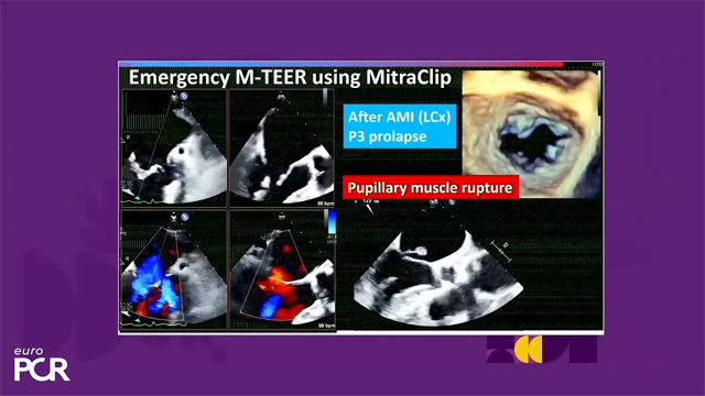 MitraClip Asian experience: clinical evidence and experience in challenging anatomies