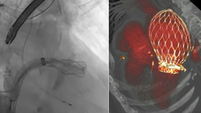 Mitral and tricuspid hotline