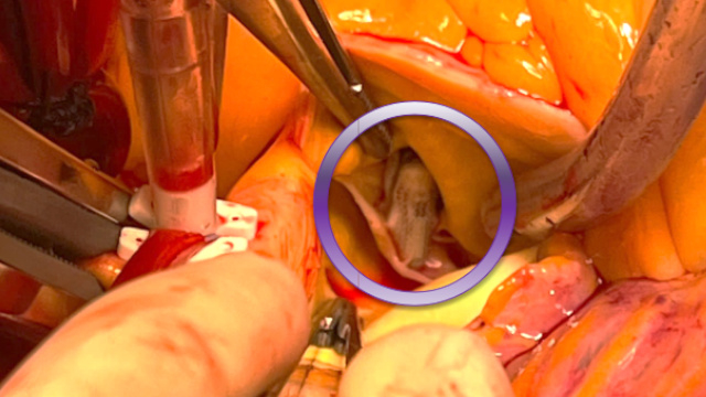 Mitral TEER challenges and complications