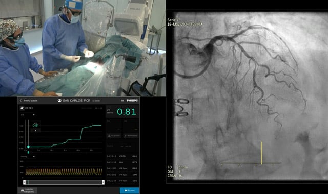 Multivessel Disease: A LIVE Educational Case from Spain