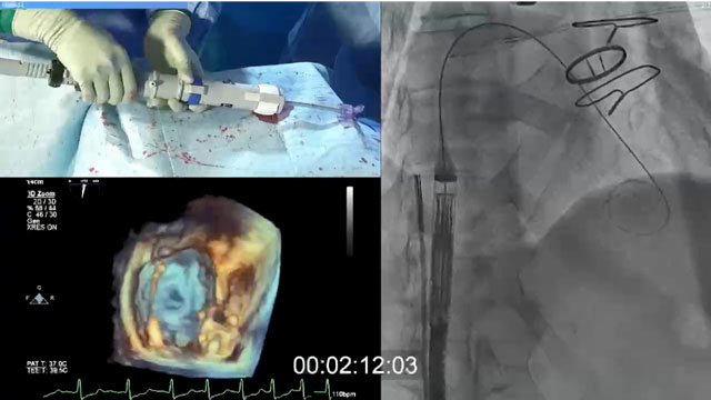 Patient management before, during, and after transcatheter tricuspid valve replacement
