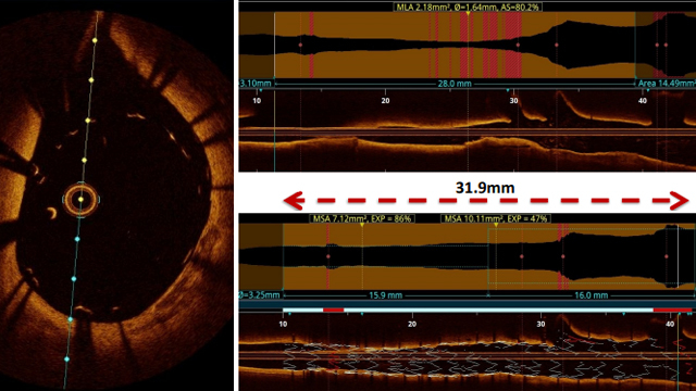 PCI complications: mistakes in stent placement, stent elongation during implantation & more