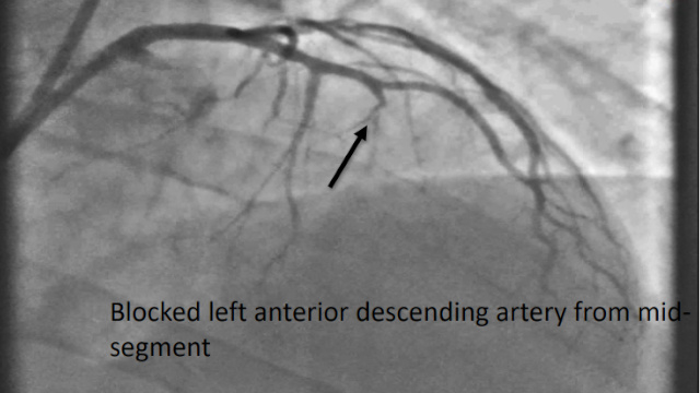 PCI in challenging coronary anatomies