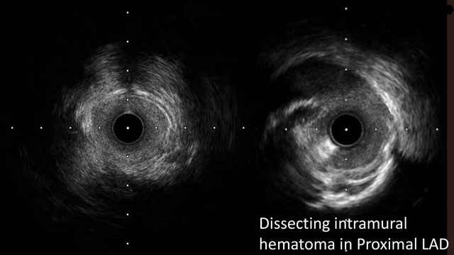 PCI of bifurcation lesions: management of complications - Part 2