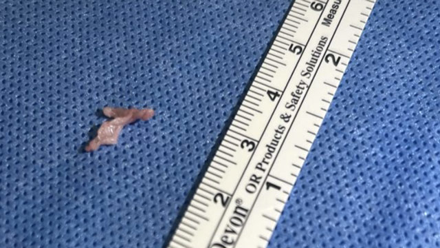 PCI of bifurcation lesions: management of complications - Part 3