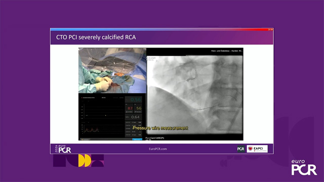 Physiology guided post-DCB treatment to safely limit stenting. Validation in complex clinical settings with the optical Optowire III pressure guide