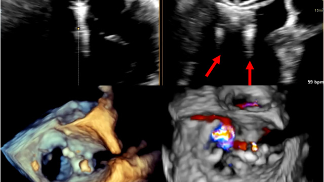 Pushing the limits of transcatheter mitral valve interventions