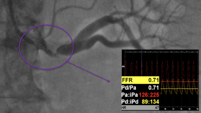 Renal interventions