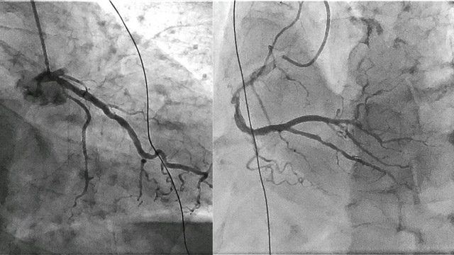 Revisiting thrombus aspiration in STEMI with continuous power aspiration system
