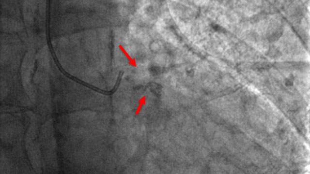 'Rock' around the clock: differential use of the dedicated tools to deal with coronary calcific lesions