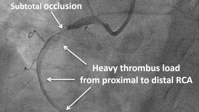 STEMI: thrombus is the problem