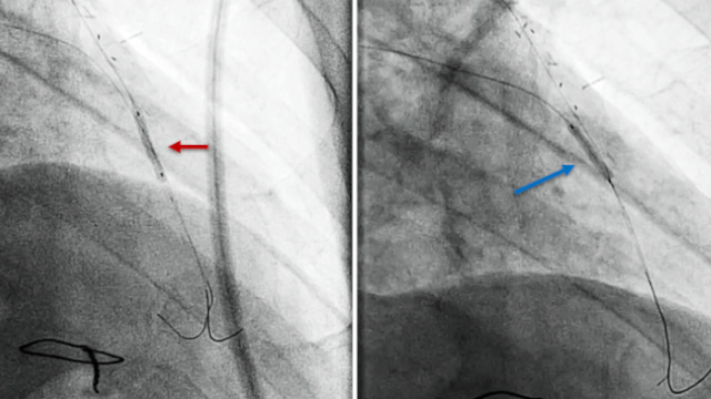 Stentless PCI