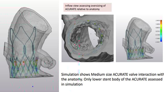 TAVI: how to deal with aortic regurgitation