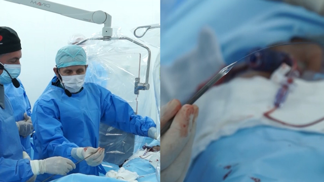 TAVI: how to prevent stroke