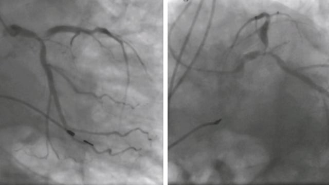 TAVI in cardiogenic shock