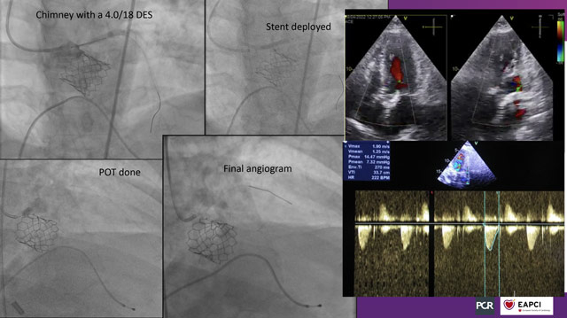 Navigating TAVI Complications: Strategies for Success