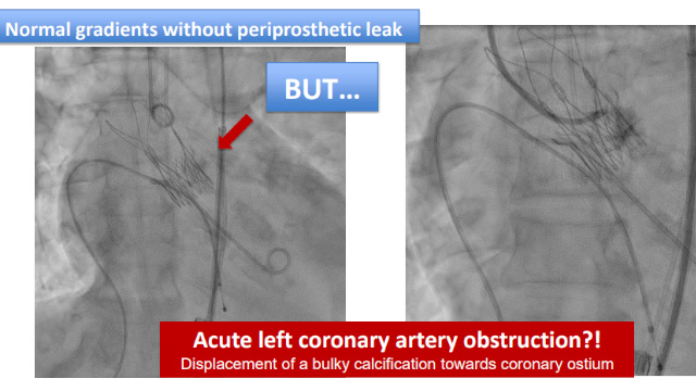 TAVI: procedural complications - Part 2